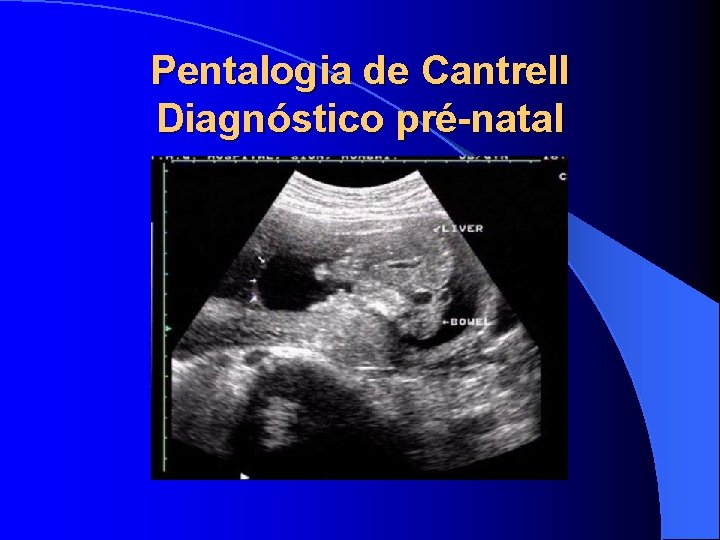 Pentalogia de Cantrell Diagnóstico pré-natal 