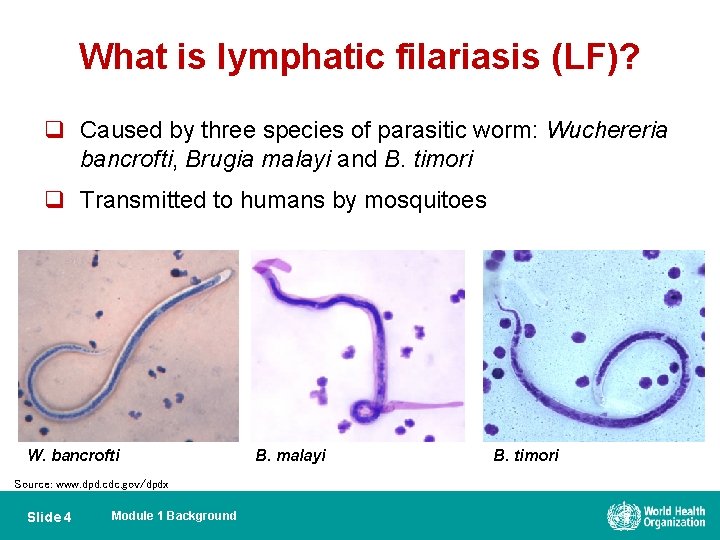 What is lymphatic filariasis (LF)? q Caused by three species of parasitic worm: Wuchereria