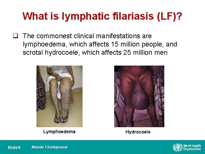 What is lymphatic filariasis (LF)? q The commonest clinical manifestations are lymphoedema, which affects