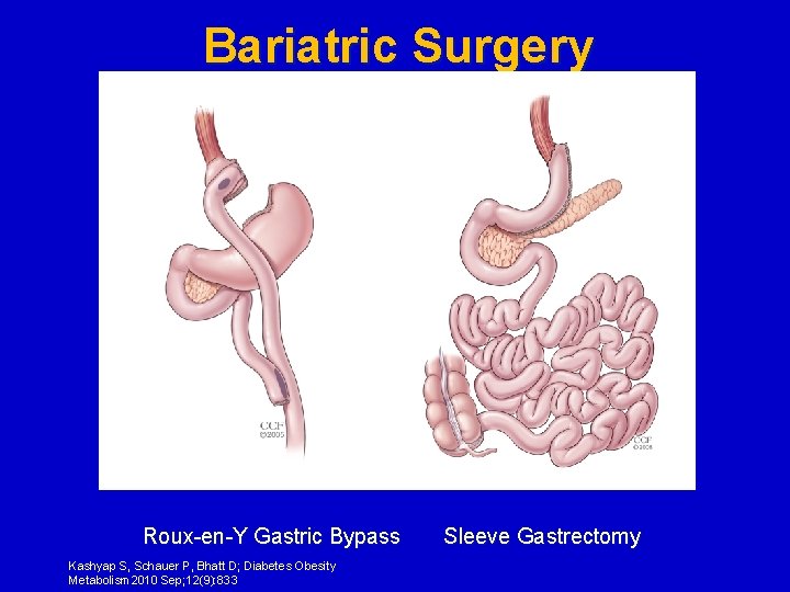 Bariatric Surgery Roux-en-Y Gastric Bypass Kashyap S, Schauer P, Bhatt D; Diabetes Obesity Metabolism