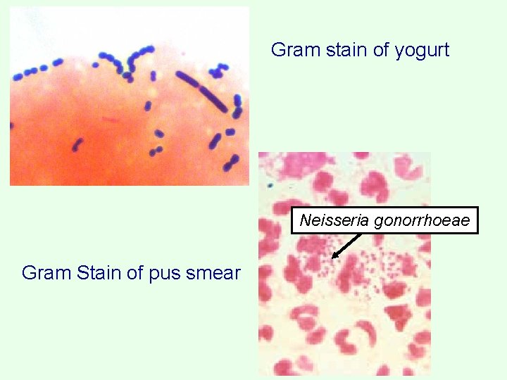 Gram stain of yogurt Neisseria gonorrhoeae Gram Stain of pus smear 