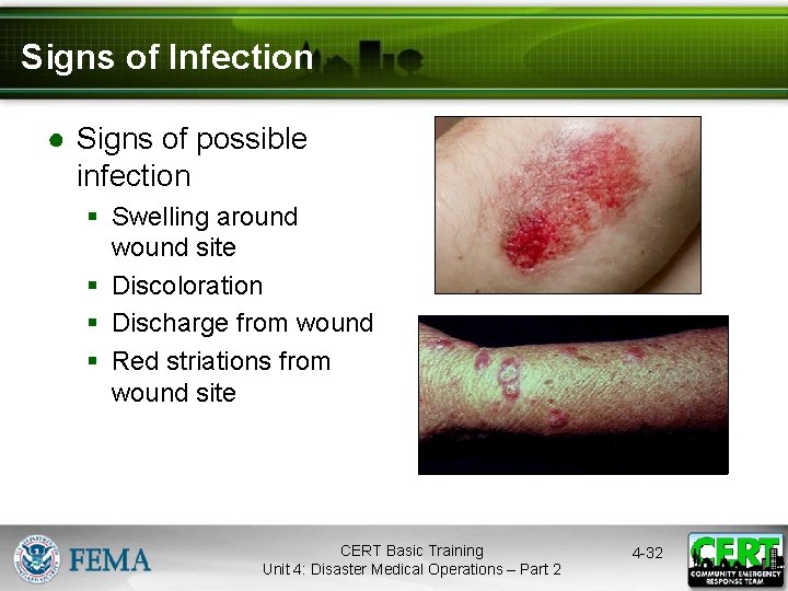 Signs of Infection ● Signs of possible infection § Swelling around wound site §
