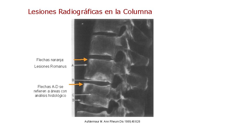Lesiones Radiográficas en la Columna: Romanus Flechas naranja: Lesiones Romanus Flechas A-D se refieren