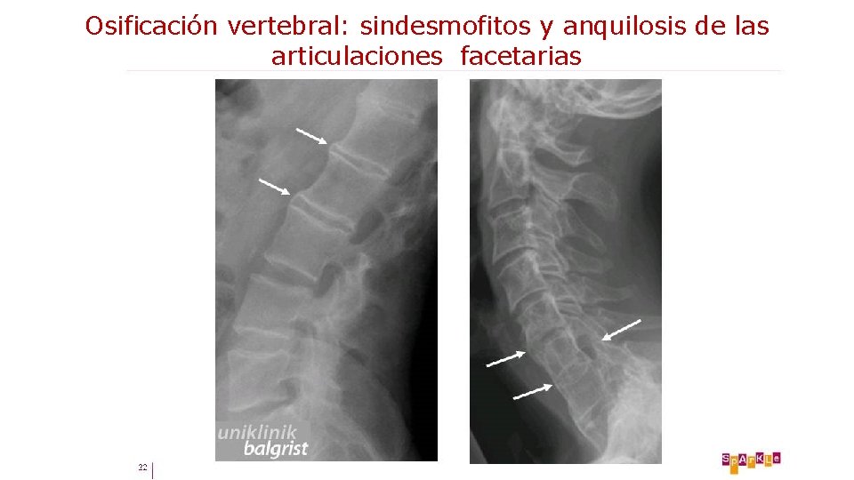 Osificación vertebral: sindesmofitos y anquilosis de las articulaciones facetarias 