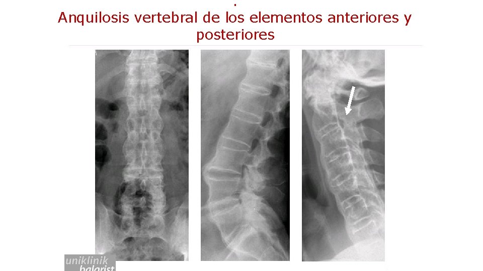 . Anquilosis vertebral de los elementos anteriores y posteriores 