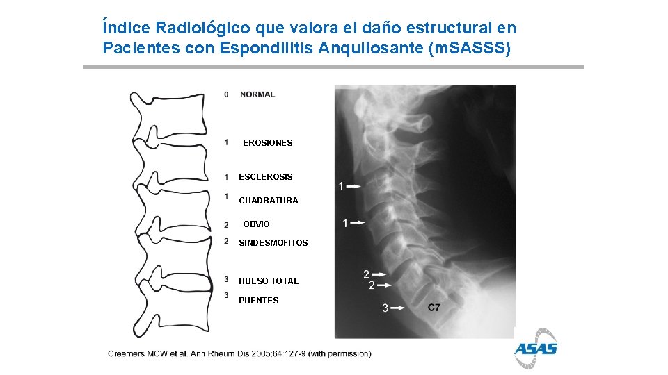 Índice Radiológico que valora el daño estructural en Pacientes con Espondilitis Anquilosante (m. SASSS)