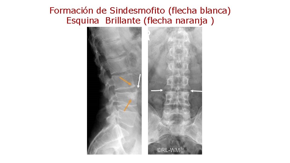 Formación de Sindesmofito (flecha blanca) Esquina Brillante (flecha naranja ) 