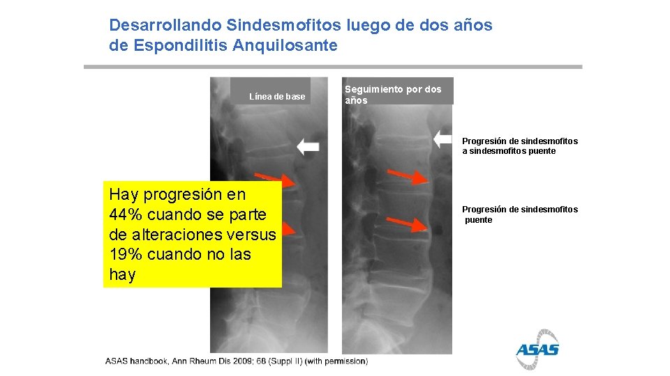 Desarrollando Sindesmofitos luego de dos años de Espondilitis Anquilosante Línea de base Seguimiento por