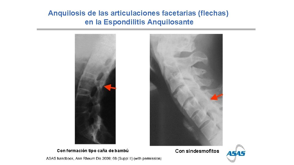 Anquilosis de las articulaciones facetarias (flechas) en la Espondilitis Anquilosante Con formación tipo caña