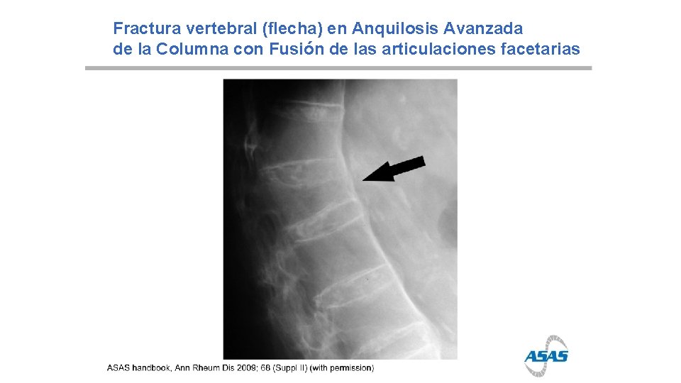 Fractura vertebral (flecha) en Anquilosis Avanzada de la Columna con Fusión de las articulaciones
