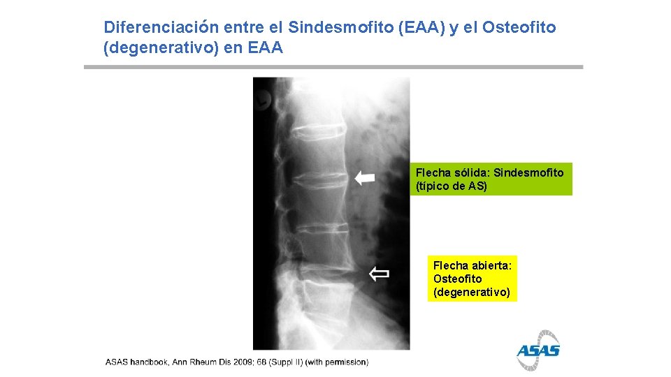 Diferenciación entre el Sindesmofito (EAA) y el Osteofito (degenerativo) en EAA Flecha sólida: Sindesmofito