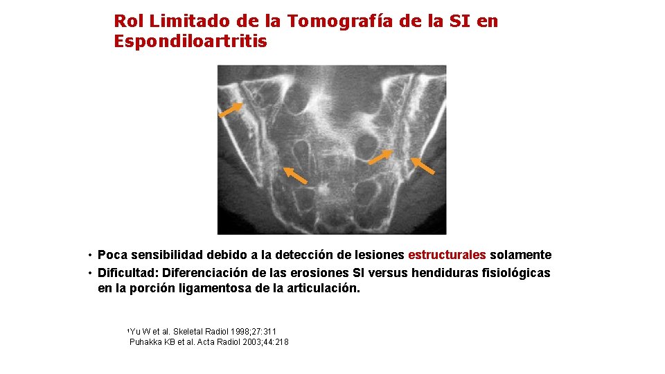 Rol Limitado de la Tomografía de la SI en Espondiloartritis • Poca sensibilidad debido