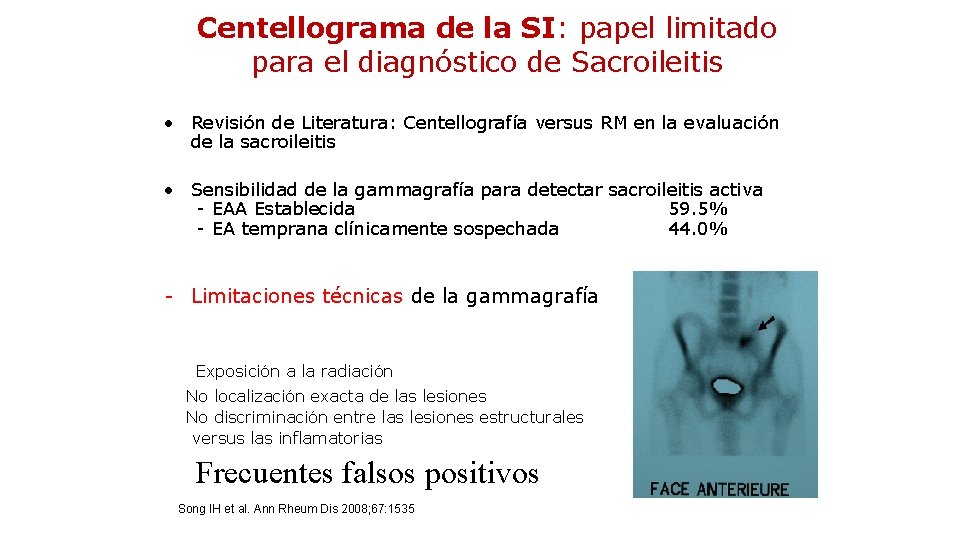 Centellograma de la SI: papel limitado para el diagnóstico de Sacroileitis • Revisión de