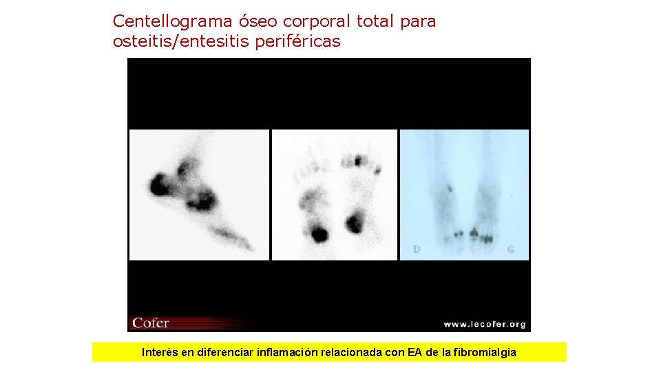 Centellograma óseo corporal total para osteitis/entesitis periféricas Interés en diferenciar inflamación relacionada con EA