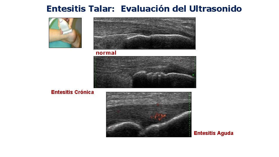 Entesitis Talar: Evaluación del Ultrasonido normal Entesitis Crónica Entesitis Aguda 