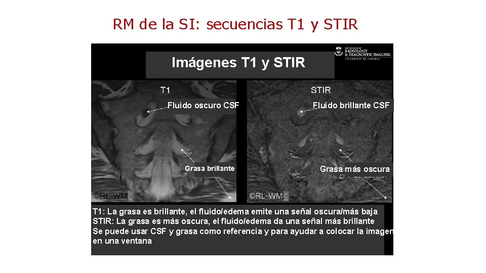 RM de la SI: secuencias T 1 y STIR Imágenes T 1 y STIR