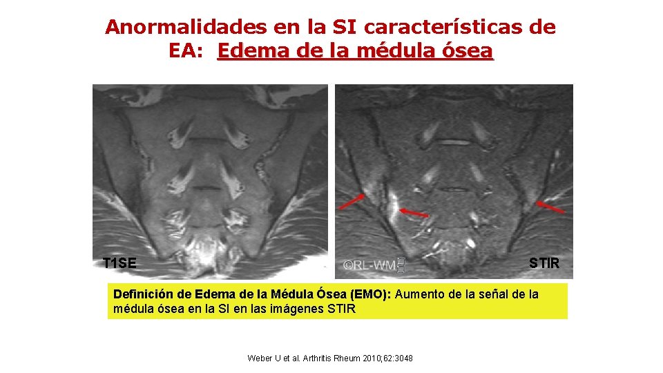 Anormalidades en la SI características de EA: Edema de la médula ósea T 1