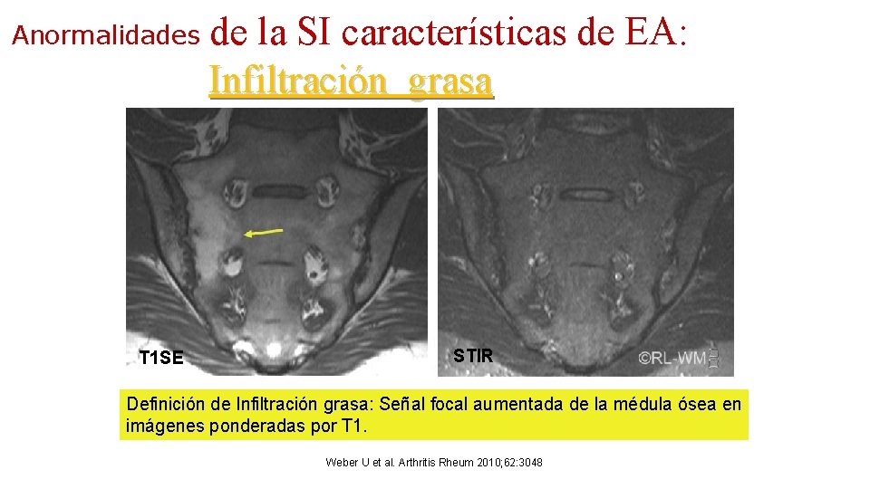 Anormalidades T 1 SE de la SI características de EA: Infiltración grasa STIR Definición