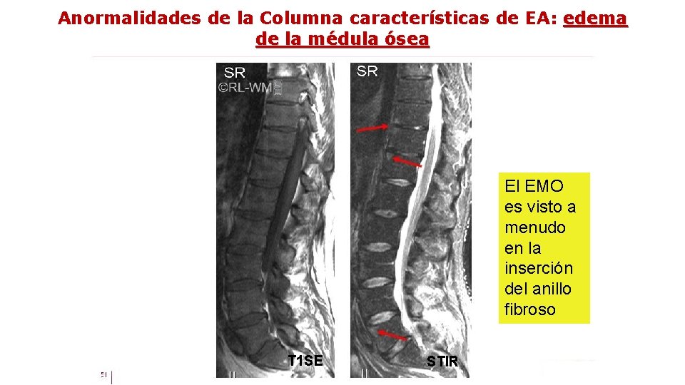 Anormalidades de la Columna características de EA: edema de la médula ósea El EMO