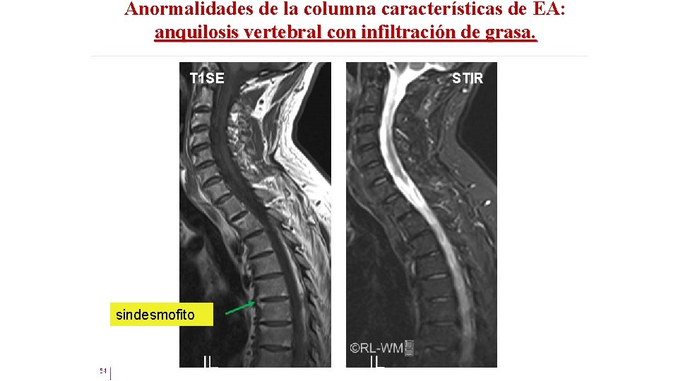 Anormalidades de la columna características de EA: anquilosis vertebral con infiltración de grasa. T
