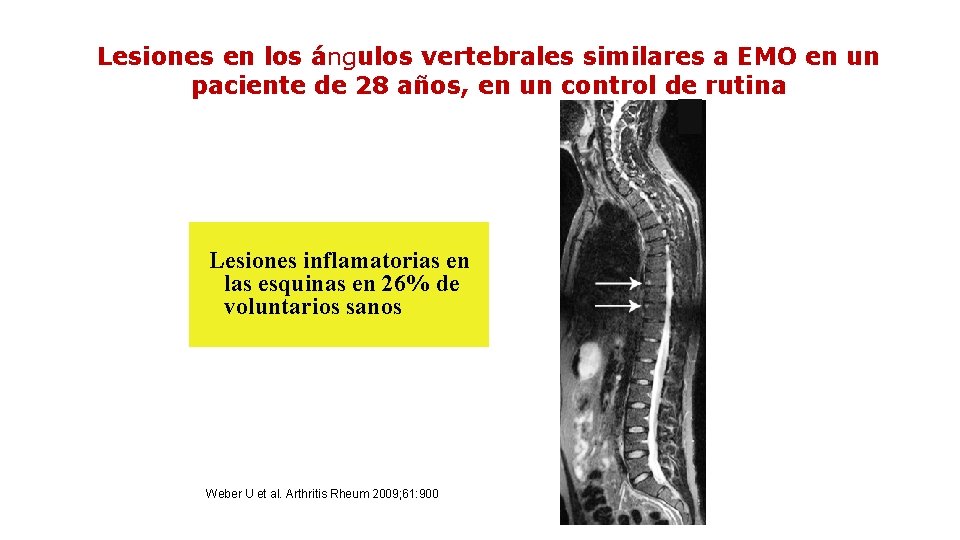 Lesiones en los ángulos vertebrales similares a EMO en un paciente de 28 años,