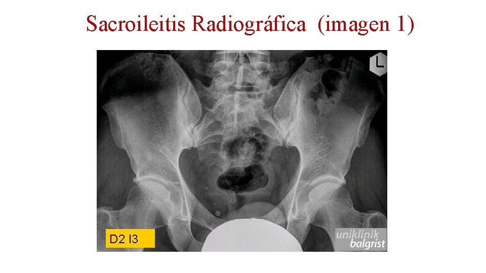 Sacroileitis Radiográfica (imagen 1) D 2 I 3 
