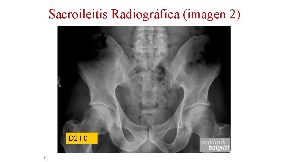 Sacroileitis Radiográfica (imagen 2) D 2 I 0 