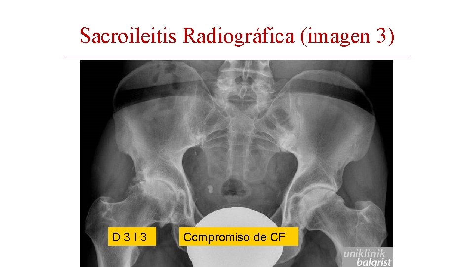 Sacroileitis Radiográfica (imagen 3) D 3 I 3 Compromiso de CF 