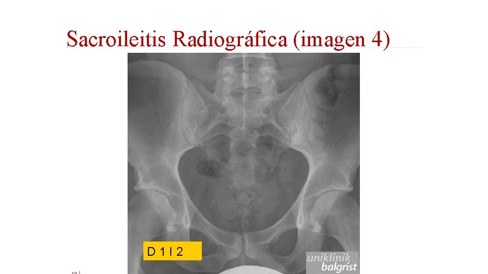 Sacroileitis Radiográfica (imagen 4) D 1 I 2 