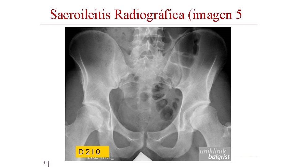 Sacroileitis Radiográfica (imagen 5) D 2 I 0 