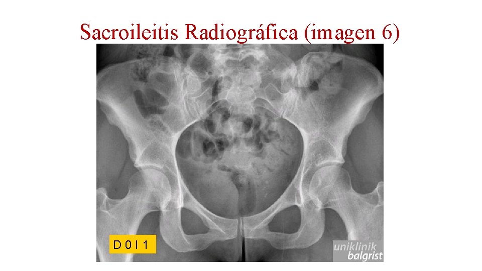 Sacroileitis Radiográfica (imagen 6) D 0 I 1 