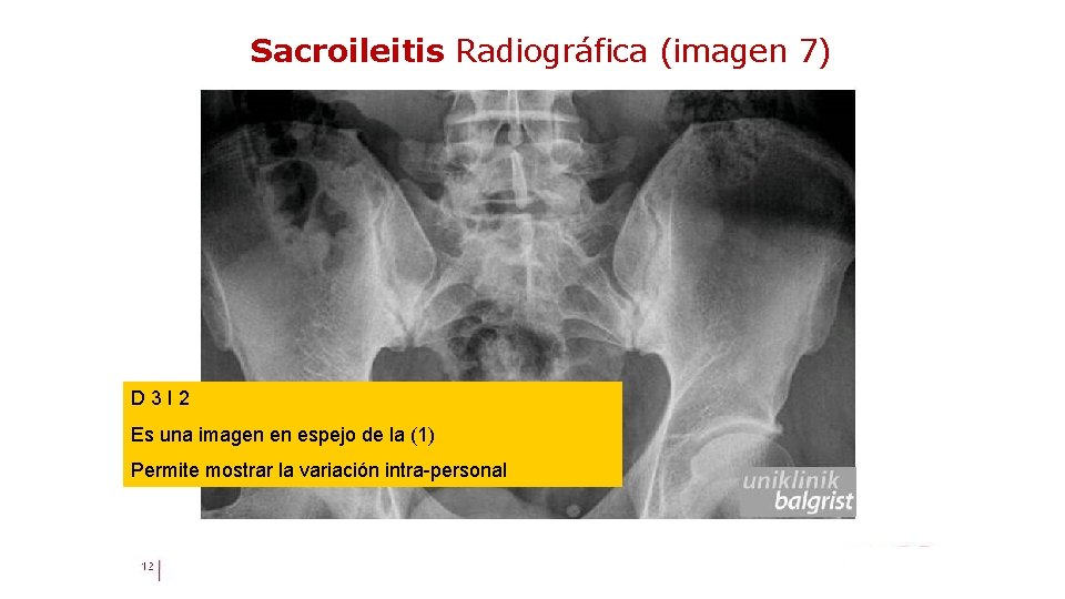 Sacroileitis Radiográfica (imagen 7) D 3 I 2 Es una imagen en espejo de