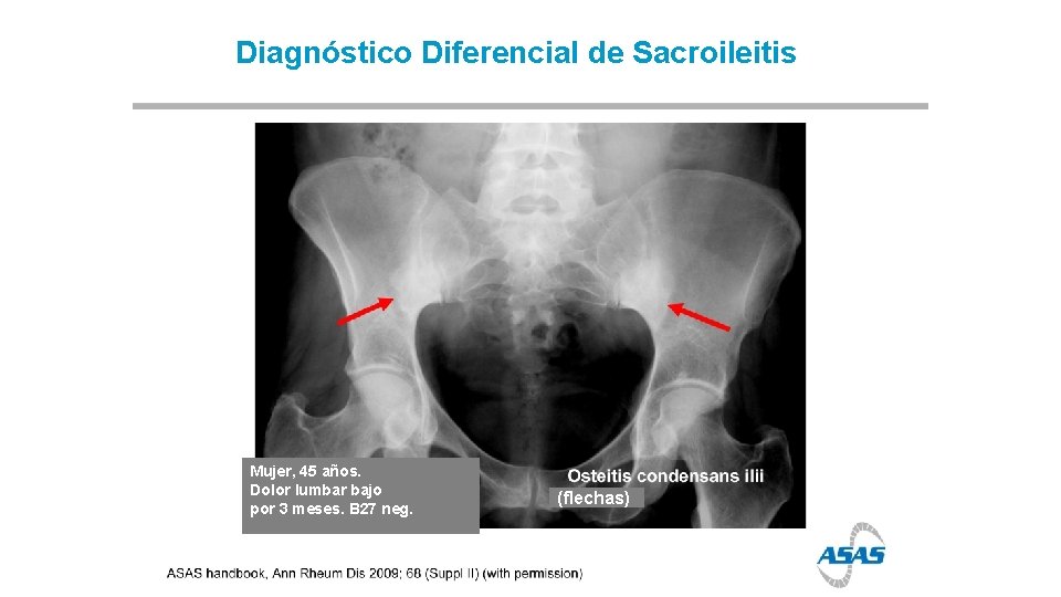 Diagnóstico Diferencial de Sacroileitis Mujer, 45 años. Dolor lumbar bajo por 3 meses. B