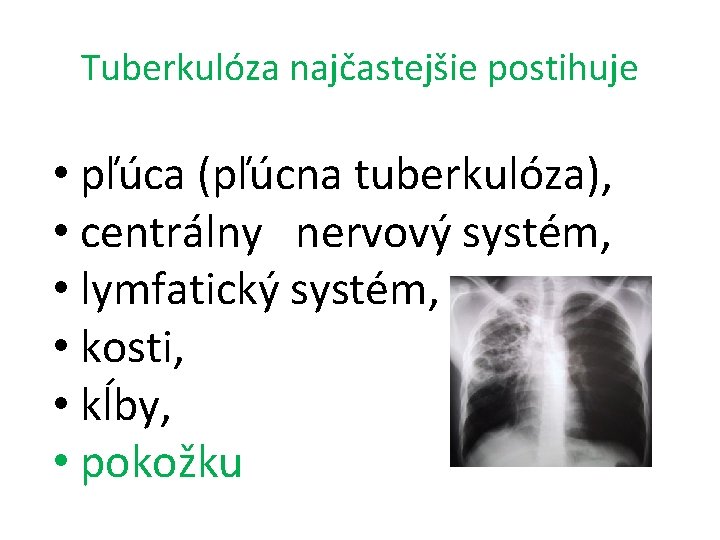 Tuberkulóza najčastejšie postihuje • pľúca (pľúcna tuberkulóza), • centrálny nervový systém, • lymfatický systém,