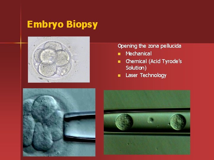 Embryo Biopsy Opening the zona pellucida n Mechanical n Chemical (Acid Tyrode’s Solution) n