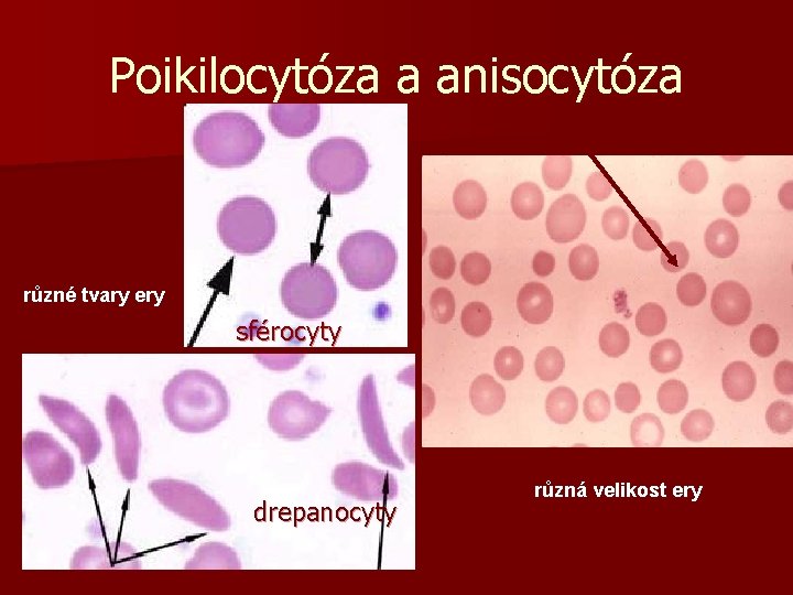 Poikilocytóza a anisocytóza různé tvary ery sférocyty drepanocyty různá velikost ery 