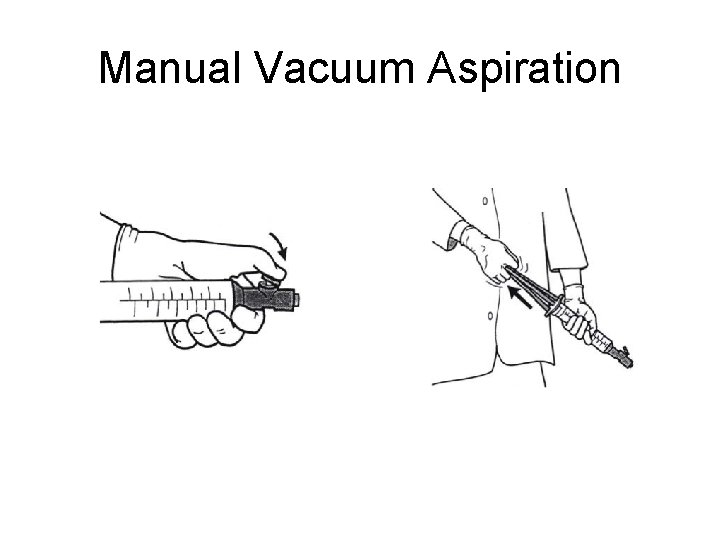 Manual Vacuum Aspiration 