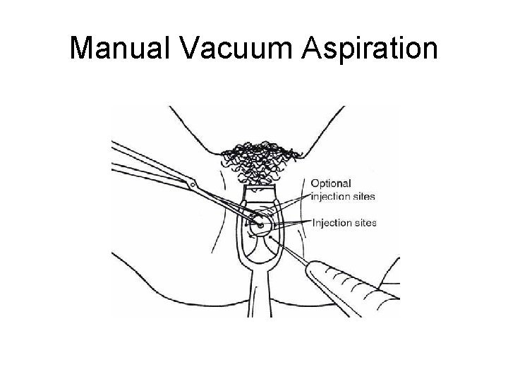 Manual Vacuum Aspiration 