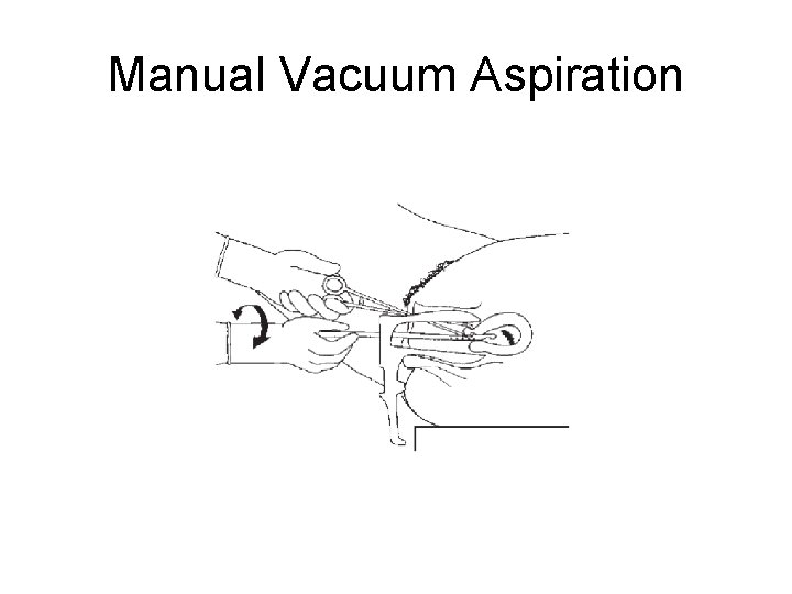 Manual Vacuum Aspiration 