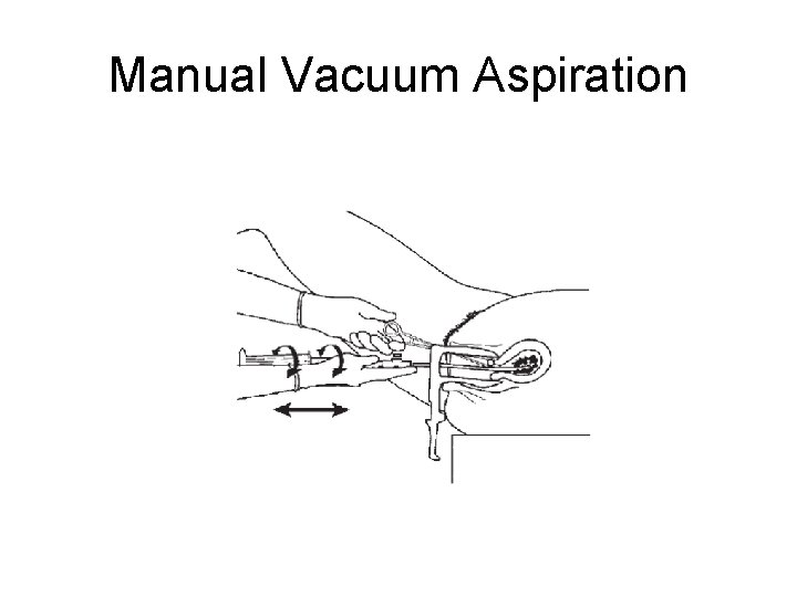 Manual Vacuum Aspiration 