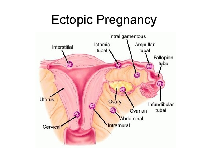 Ectopic Pregnancy 