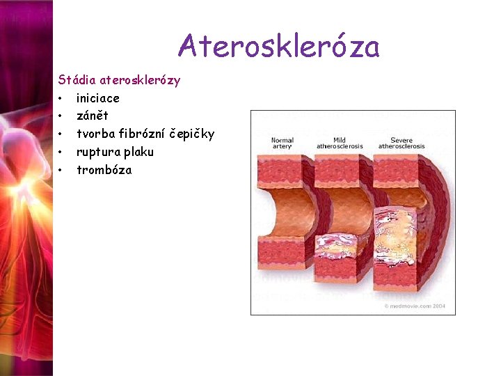 Ateroskleróza Stádia aterosklerózy • iniciace • zánět • tvorba fibrózní čepičky • ruptura plaku