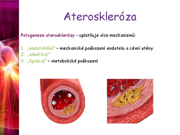 Ateroskleróza Patogeneze aterosklerózy - uplatňuje více mechanizmů: 1. „endoteliální“ – mechanické poškození endotelu a