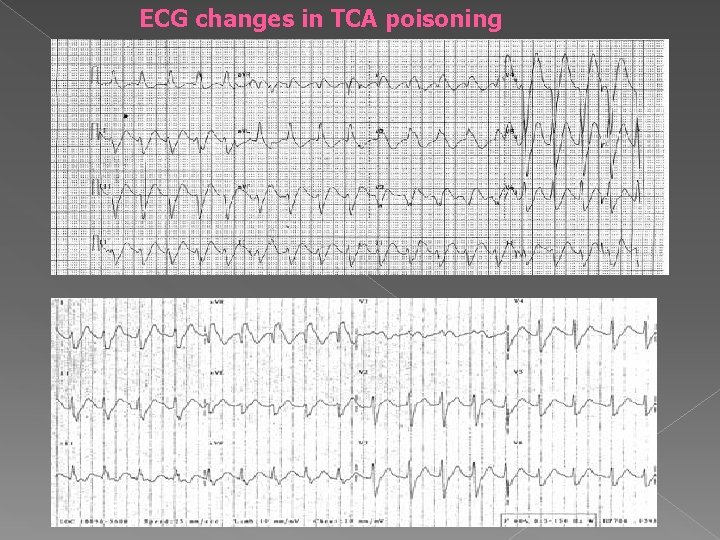 ECG changes in TCA poisoning 