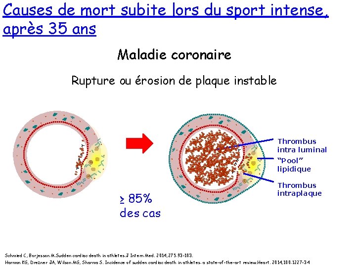 Causes de mort subite lors du sport intense, après 35 ans Maladie coronaire Rupture