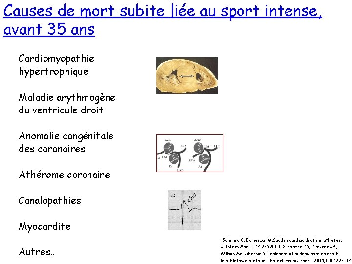 Causes de mort subite liée au sport intense, avant 35 ans Cardiomyopathie hypertrophique Maladie