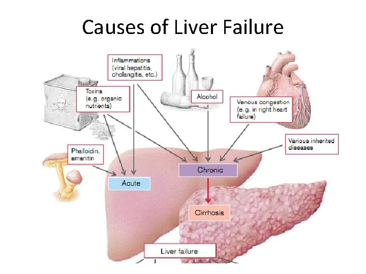 Causes of Liver Failure 