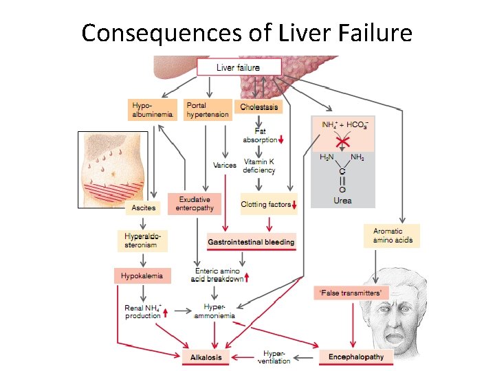 Consequences of Liver Failure 