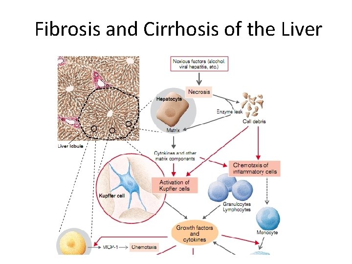 Fibrosis and Cirrhosis of the Liver 