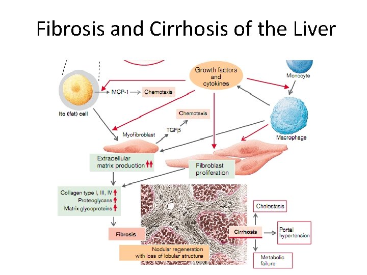 Fibrosis and Cirrhosis of the Liver 